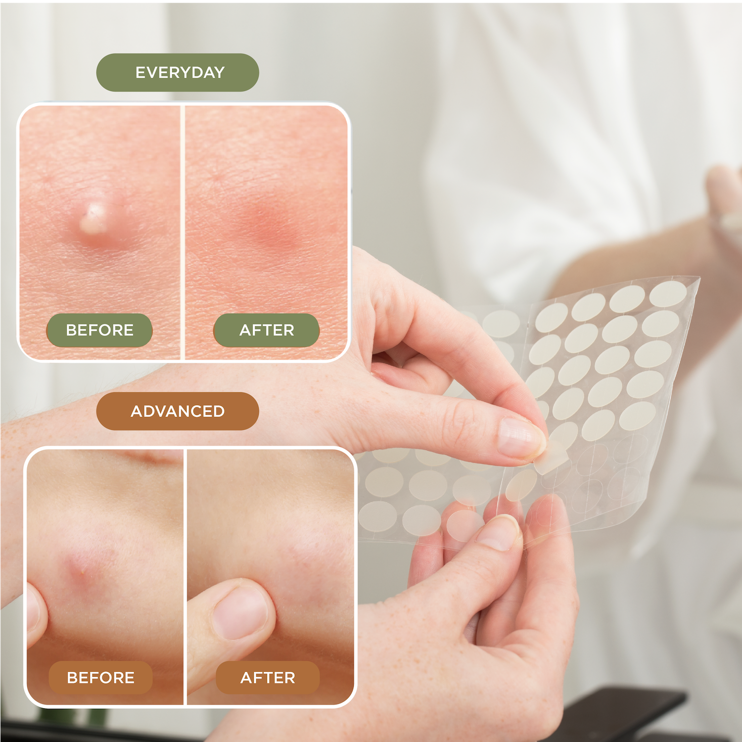 NIGHT Duplicate 272pk Pimple Patch Duo, Everyday & Advanced, 272 Ct