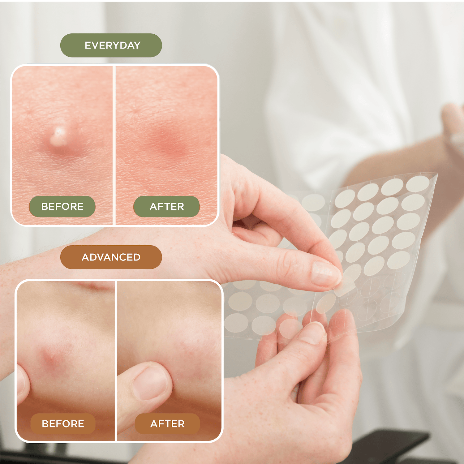 NIGHT Duplicate 272pk Pimple Patch Duo, Everyday & Advanced, 272 Ct