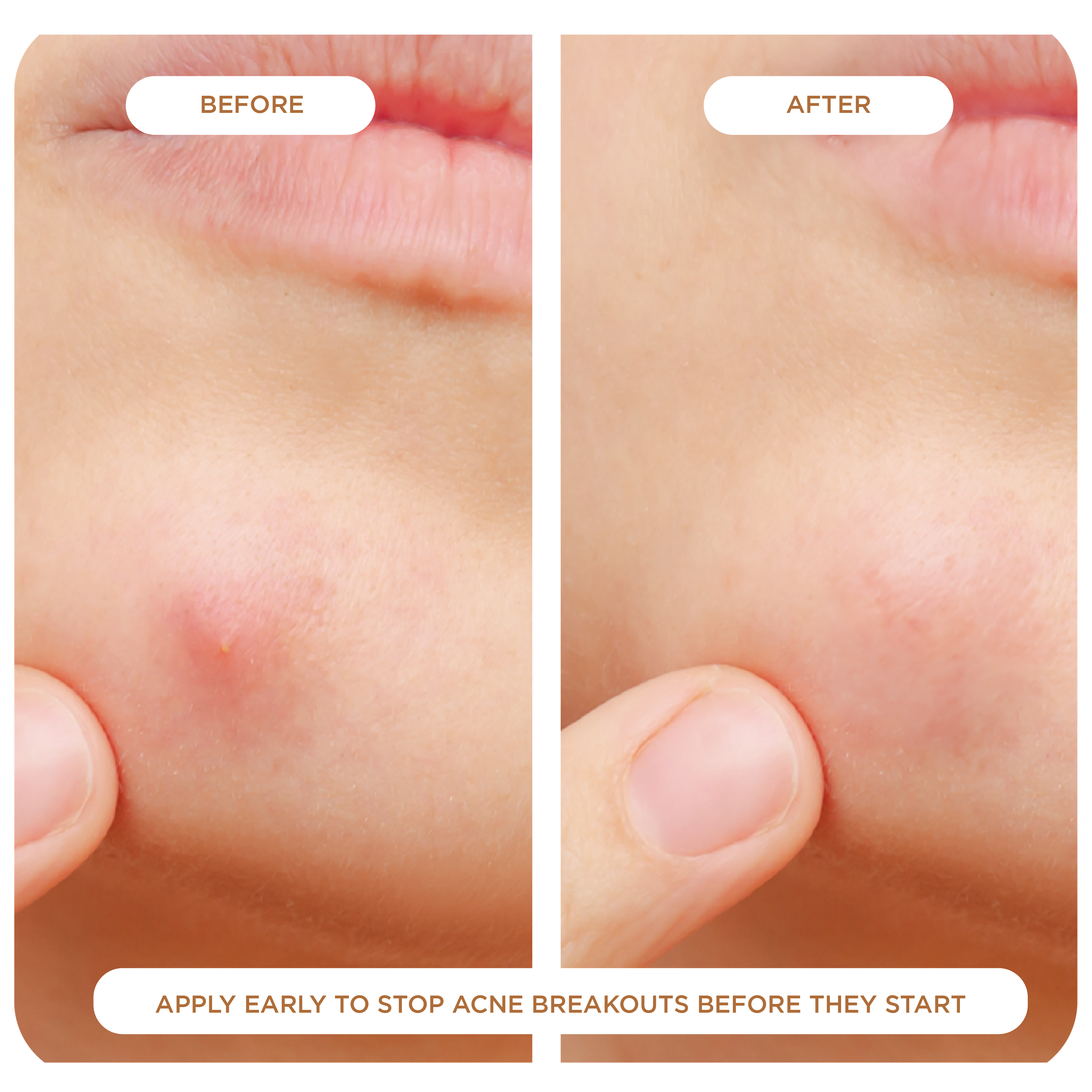 NIGHT Duplicate 48 Count Advanced Pimple Patches, 48 Ct