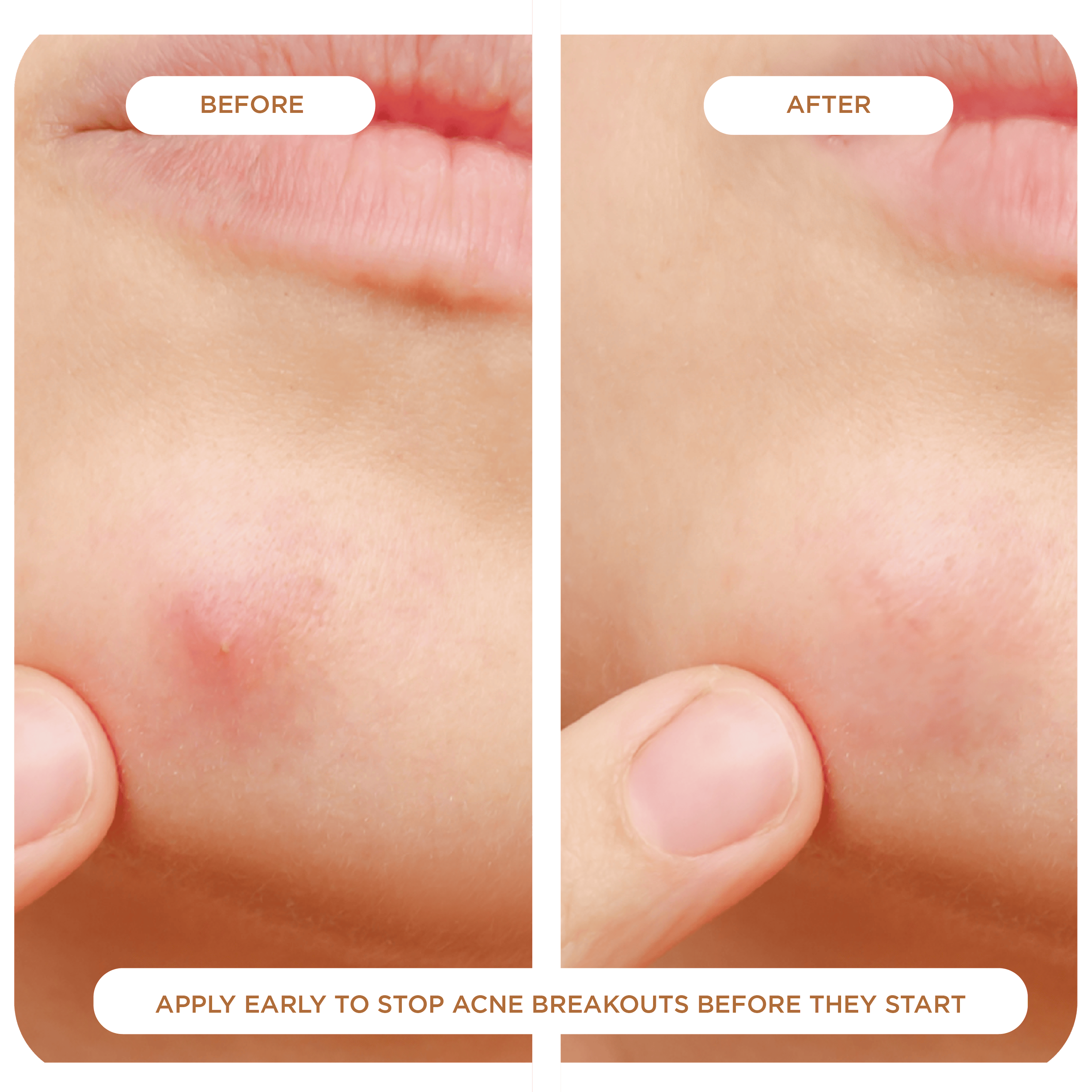 NIGHT Duplicate 48 Count Advanced Pimple Patches, 48 Ct