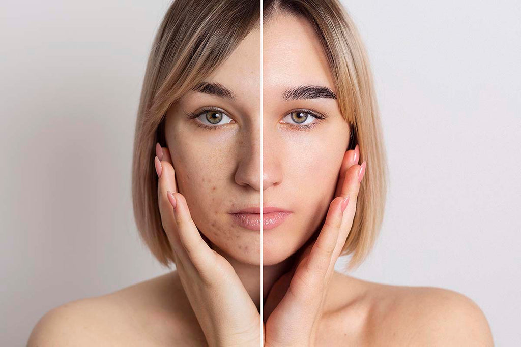 Before and after photo of woman with blemishes to clear skin