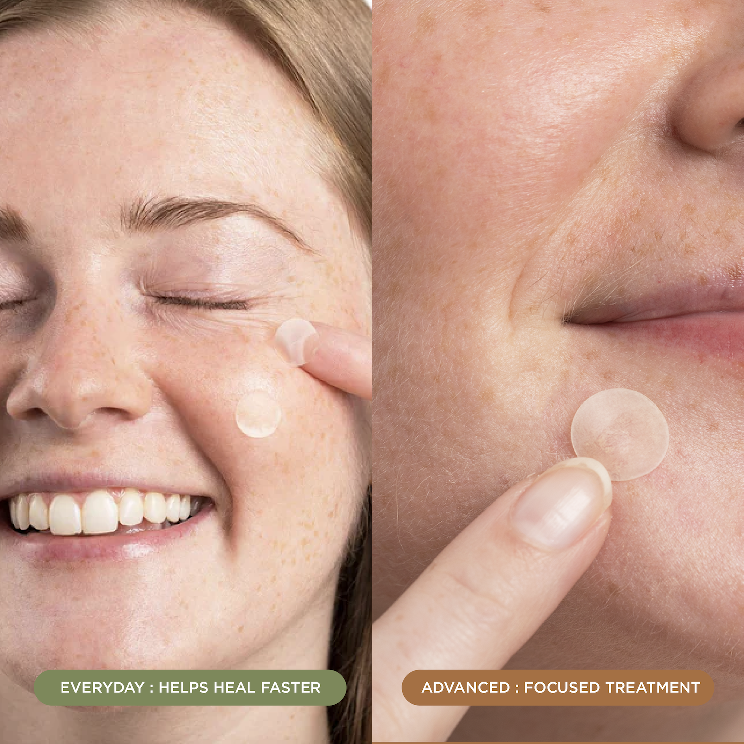 NIGHT Duplicate 272pk Pimple Patch Duo, Everyday & Advanced, 272 Ct