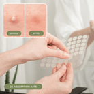 NIGHT Duplicate Everyday Pimple Patches, Ultra Value Pack, 224 Ct